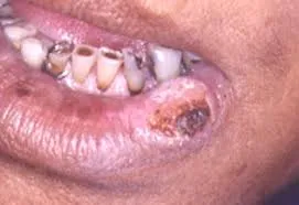 oral cancer