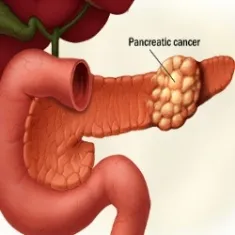 (Courtesy:www.ladycarehealth.com)