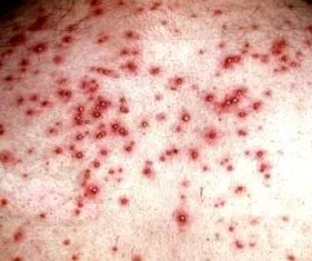 (Pic courtesy: microbiologybytes. wordpress.com)