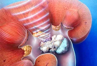 pic: www.webmd.com