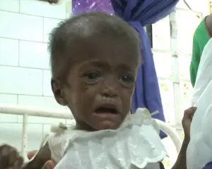 nagada _malnutrition copy