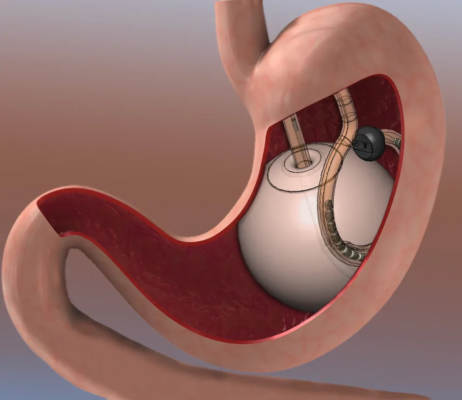 Pic Courtesy: www.obesitysurgeryindia.net