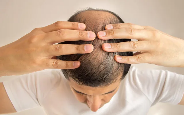 Hair Loss: 7 Types And Ayurvedic Ways To Cure It – Vedix
