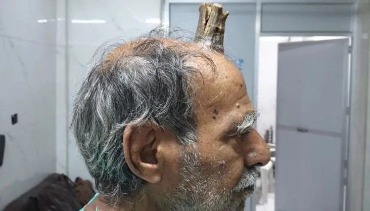 Image result for madhya-pradesh-a-74-year-old-man-successful-operation-who-suffering-from-sebaceous-horn