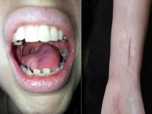 Woman loses tongue to cancer, gets new one made from her arm