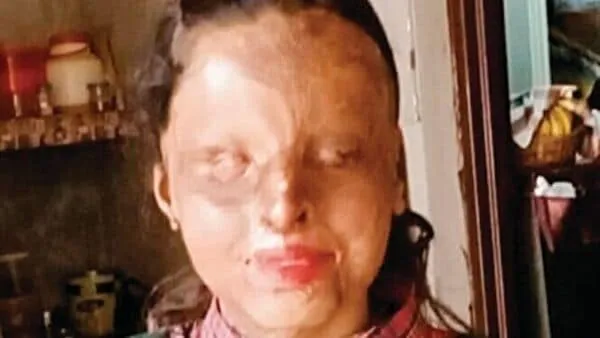 CBSE Class 10 exam results: Acid attack survivor tops in school with 95% | Mint