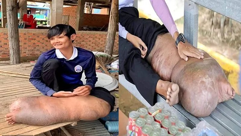 
<p>गरीबी से जूझ रहे बोंग के माता - पिता मजदूरी का काम करते थे। उनके पास बेटा का इलाज करवाने तक के लिए पैसे नहीं थे।</p></p>
<p> 