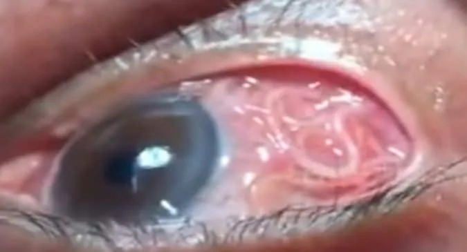 Bizarre! Doctor pulls out 15-cm-long worm from patient's eye | TheHealthSite.com