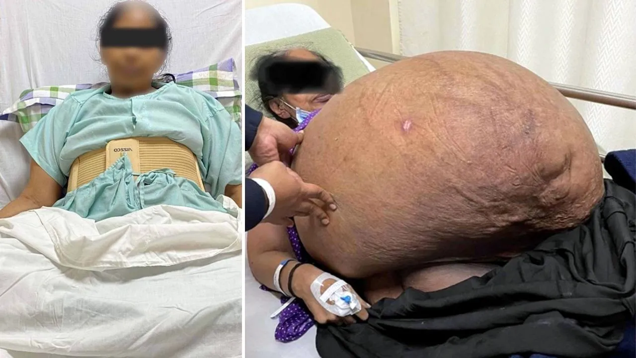 In Ahmedabad, doctors removed 47 kg tumor from the woman's stomach, which was as much as the patient's weight! CB News | crazybollywood.com