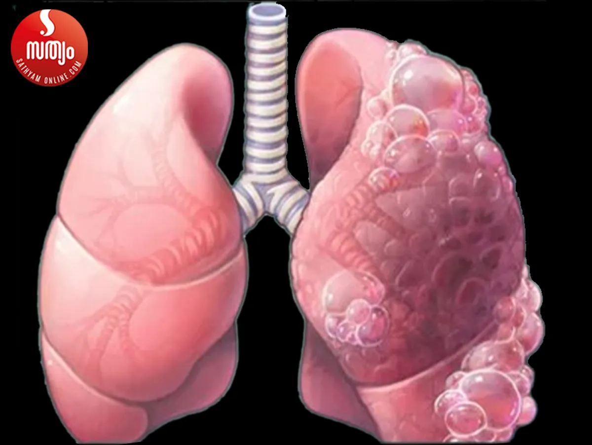 copd disease