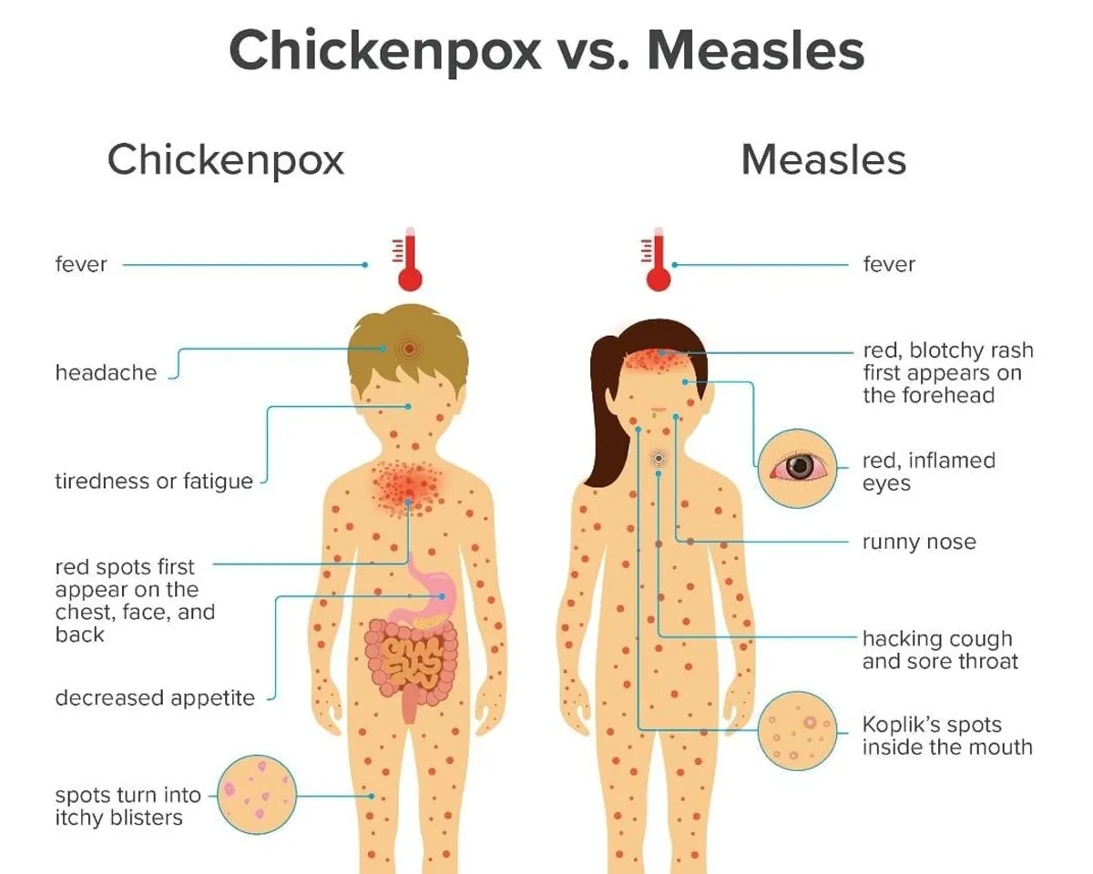 Measles-3