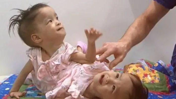 Conjoined Bhutanese Twins Who Separation Surgery