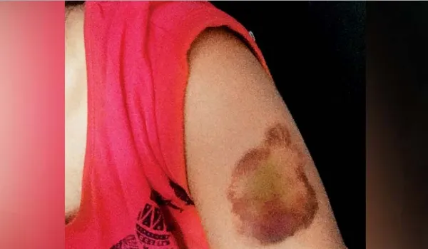 Pune girl beaten (Pic Credit Mid-day)