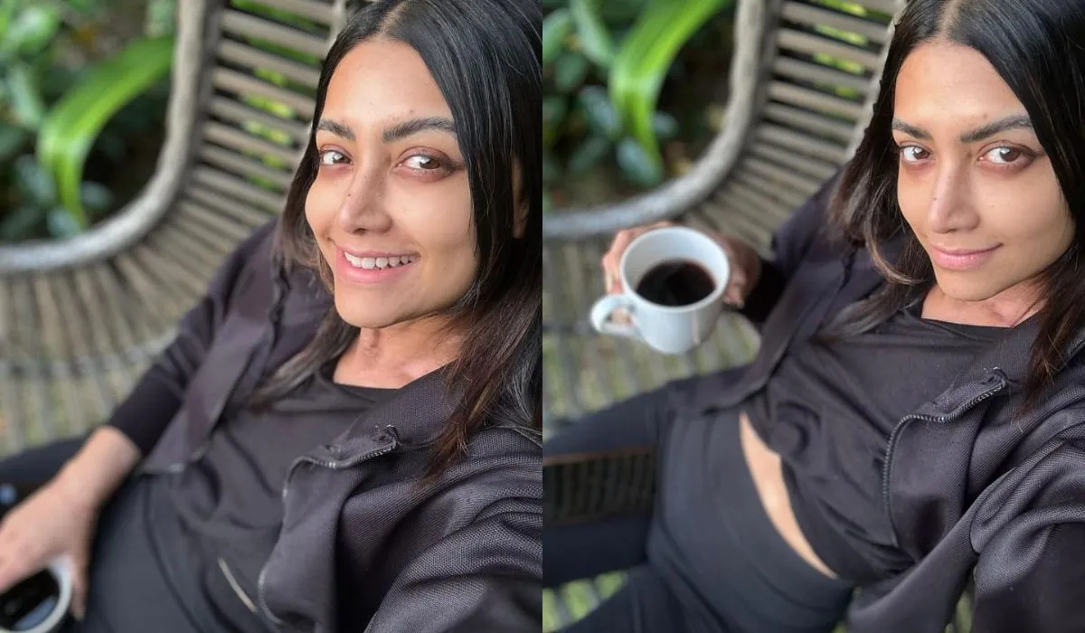 Mamta Mohandas On Vitiligo