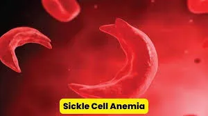 Sickle Cell Anemia: सिकल सेल ...