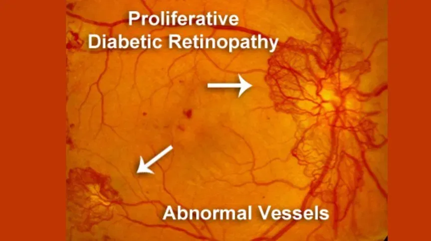 diabetic retinopathy