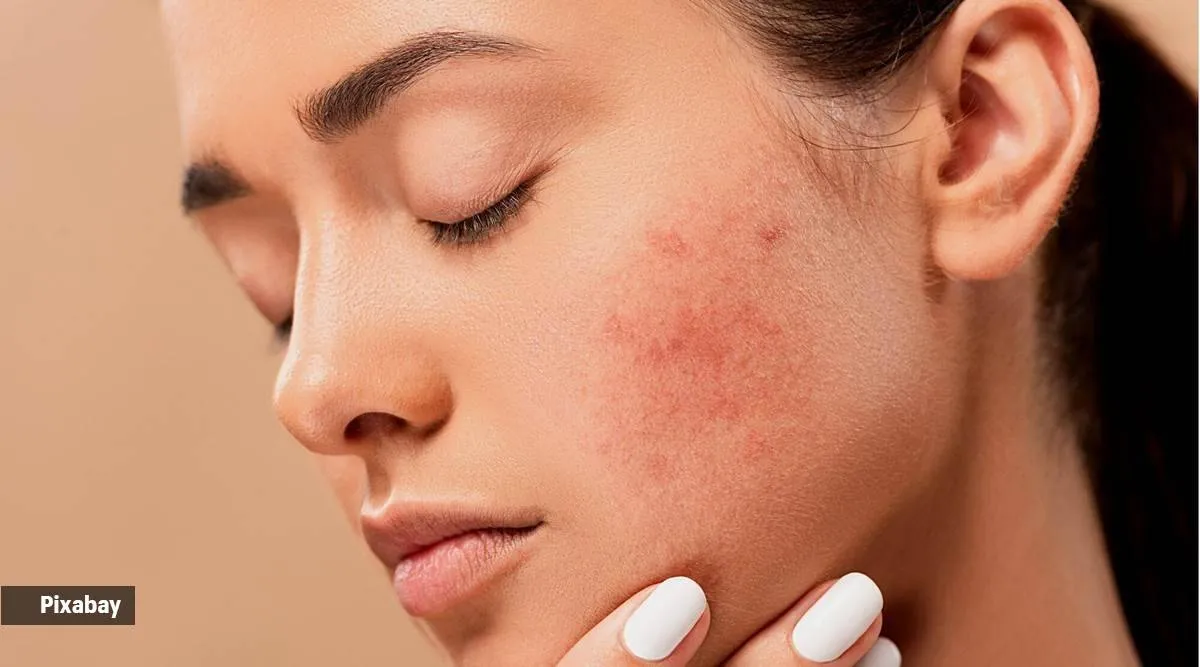 pimple treatment