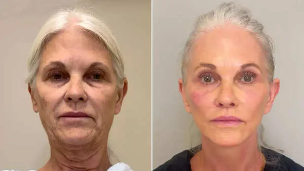 Cosmetic procedure (1)