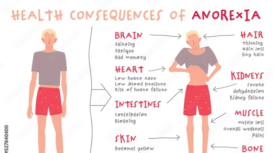 The Silent Battle: Anorexia Nervosa in Males