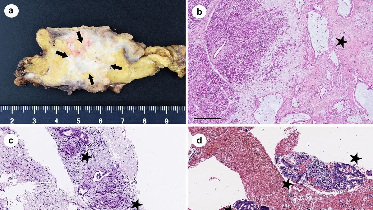 World's First Endoscopic Ultrasound-Guided Core Biopsy of Pancreatic ...