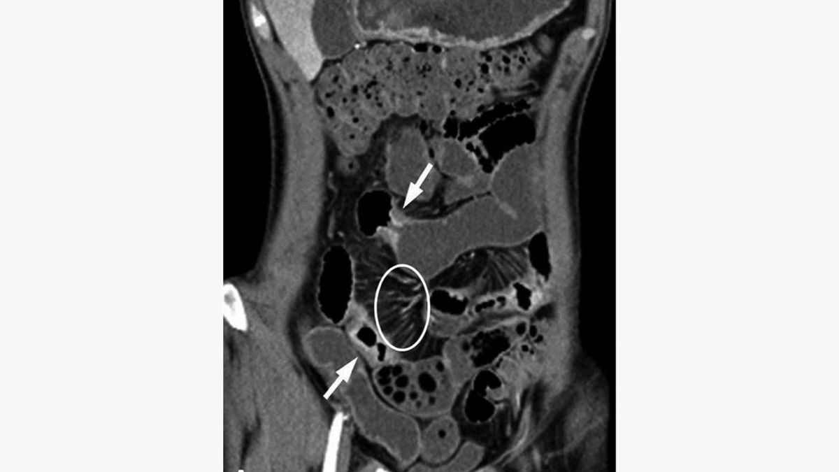 The Hidden Risks of CT Scans: Contrast Media Extravasation in Crohn's ...