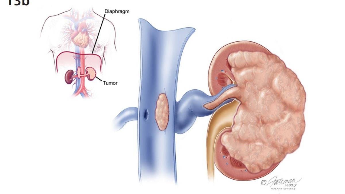 Decoding Kidney Cancer and Kidney Cysts Unveiling Their Differences