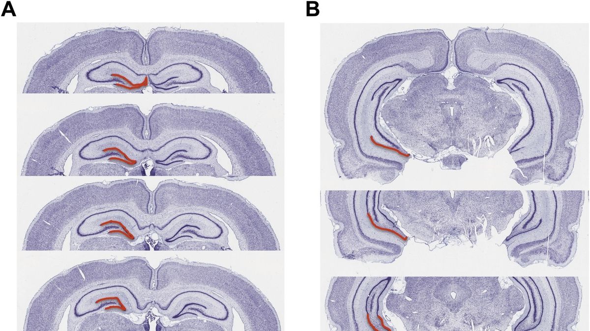 Stress Can Damage Brain