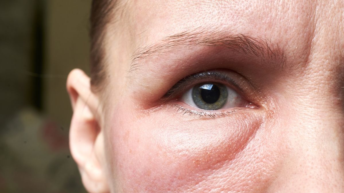 iron deficiency anemia eyes