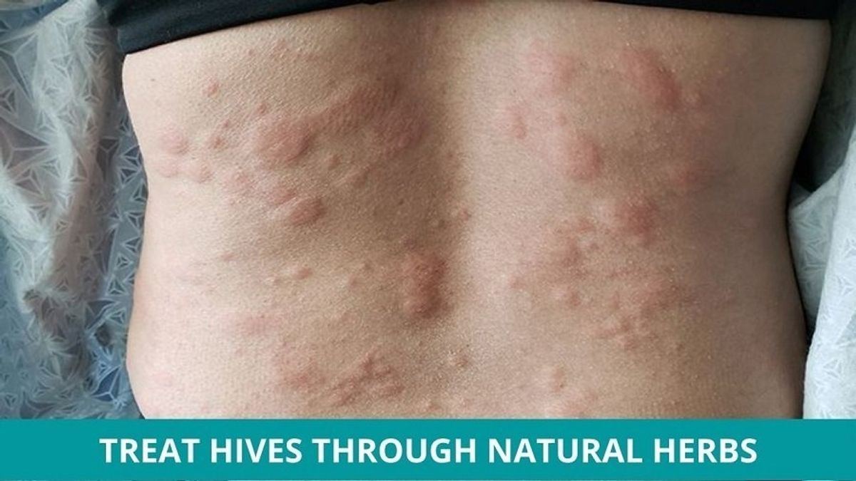 urticaria-hives-treatment-a-traditional-korean-medicine-perspective