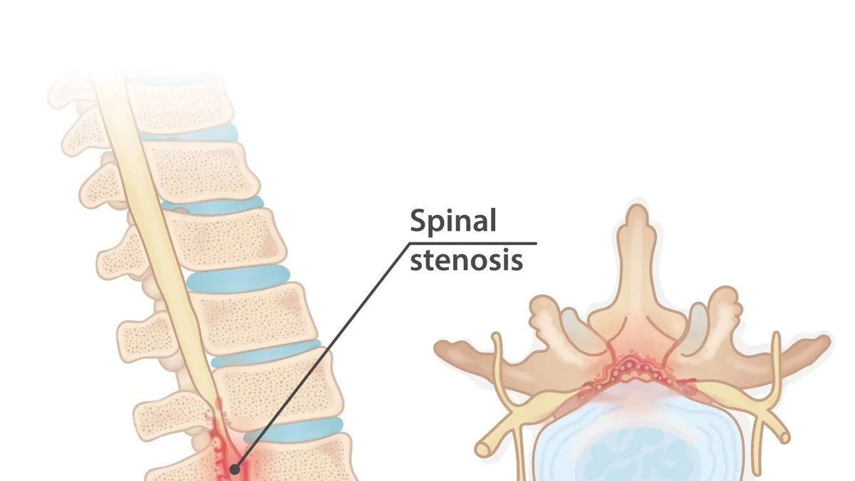 Understanding Spinal Stenosis: Causes, Symptoms, and Treatment