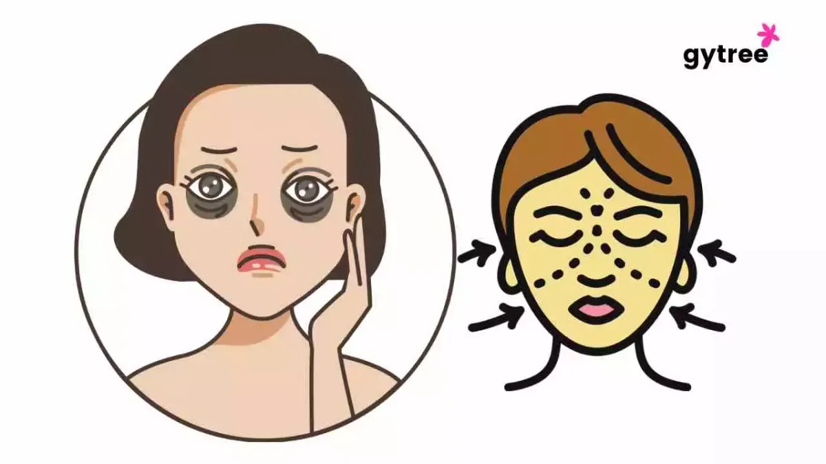 7 Basic causes Dark Circles you must know!