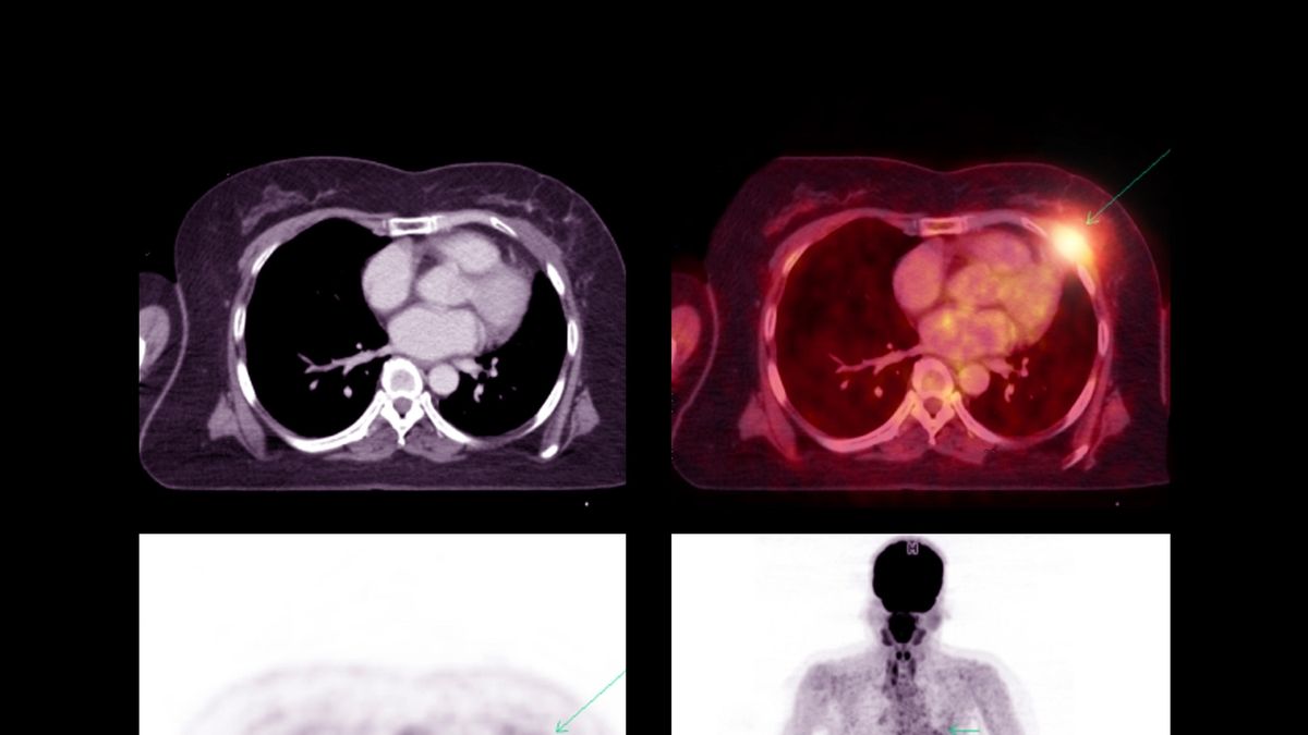 Understanding the Risk of Lung Cancer Post Smoking Cessation