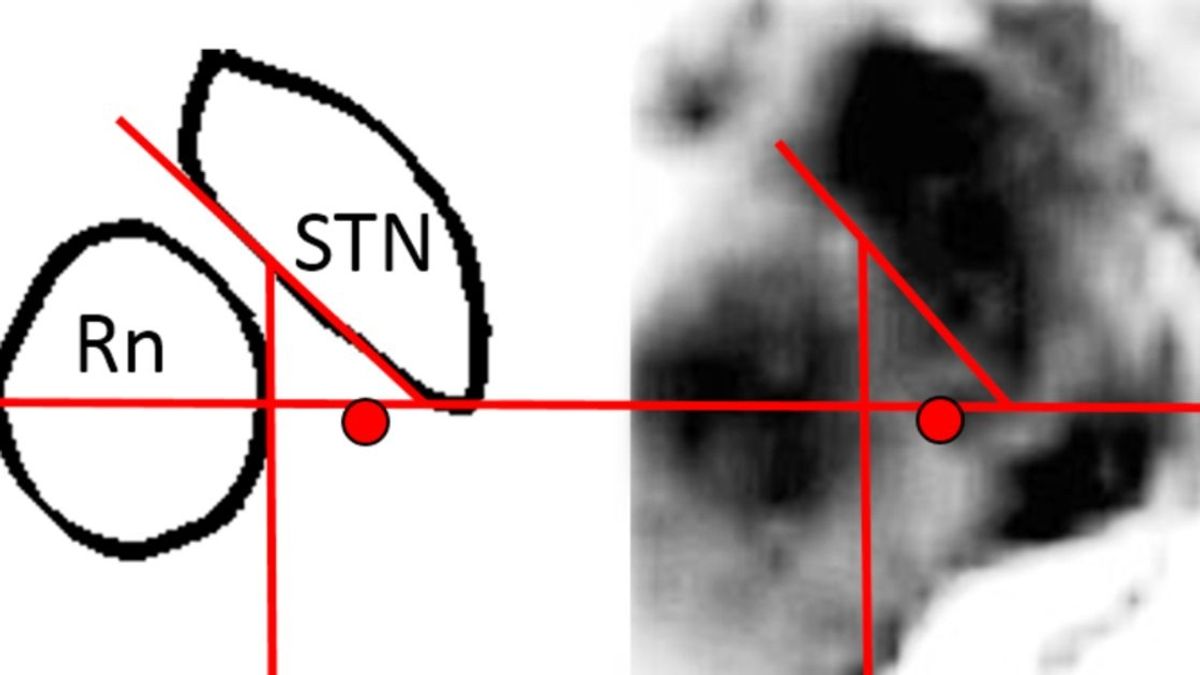 Deep Brain Stimulation Targeting the cZi: A Breakthrough in Treating ...