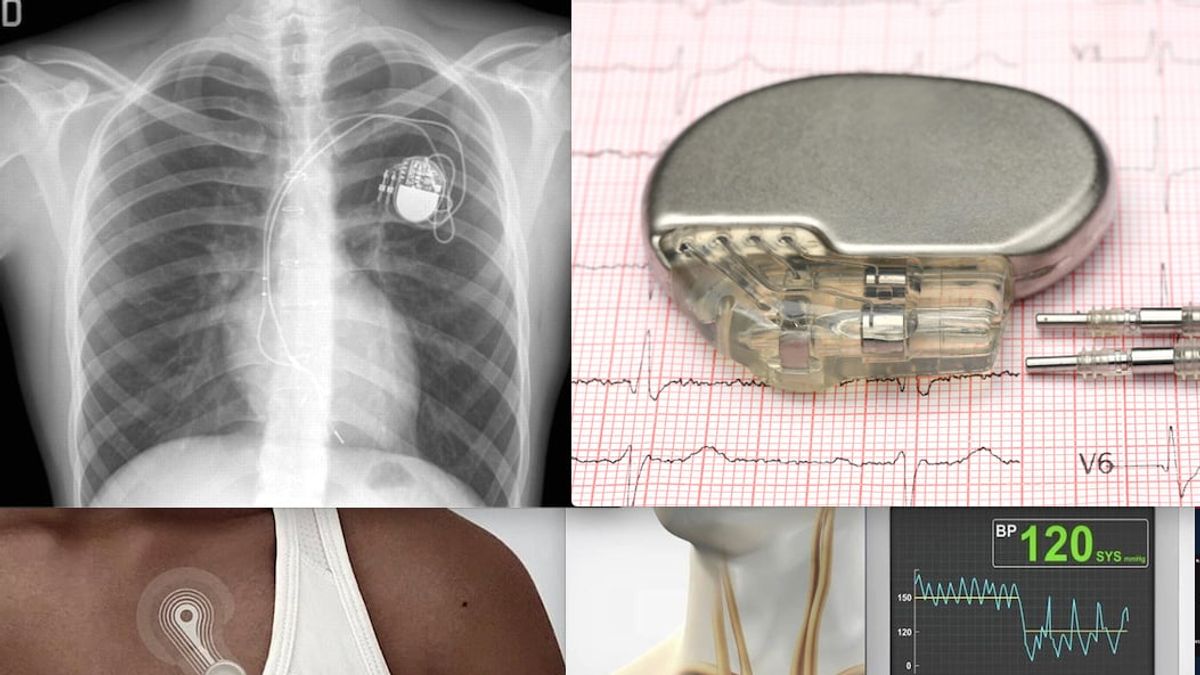 Understanding the Heart's Electrical System and the Role of Implantable ...