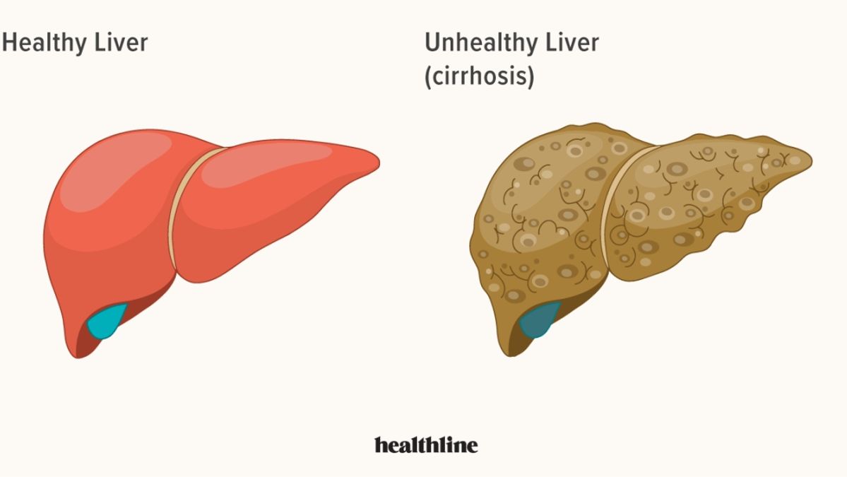 A Paradigm Shift in Liver Disease Terminology: Understanding MASLD ...