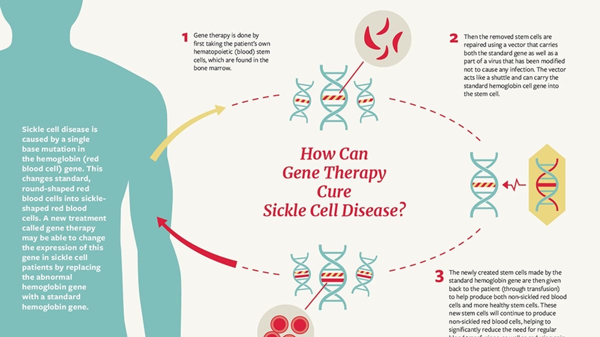 Gene therapy for sickle cell disease passes key preclinical test — Harvard  Gazette