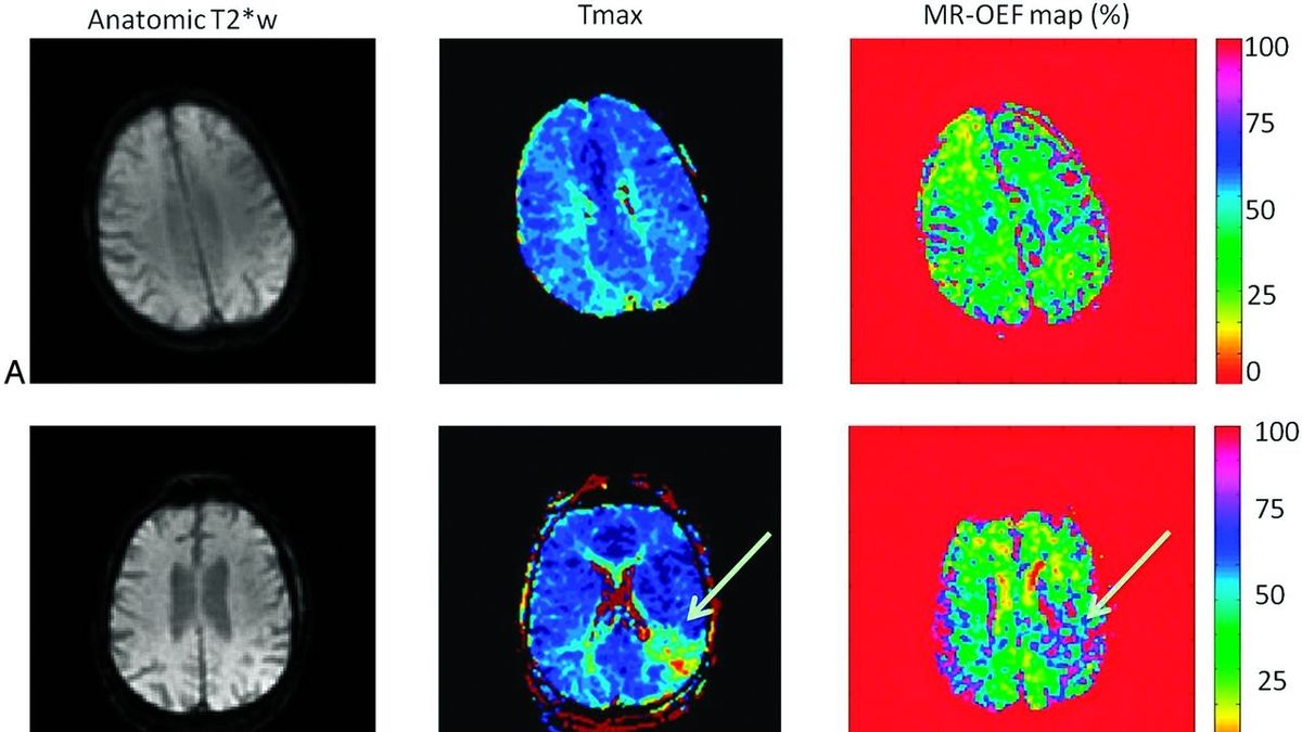 Understanding Brain Oxygenation A Pathway to Neurological Resilience