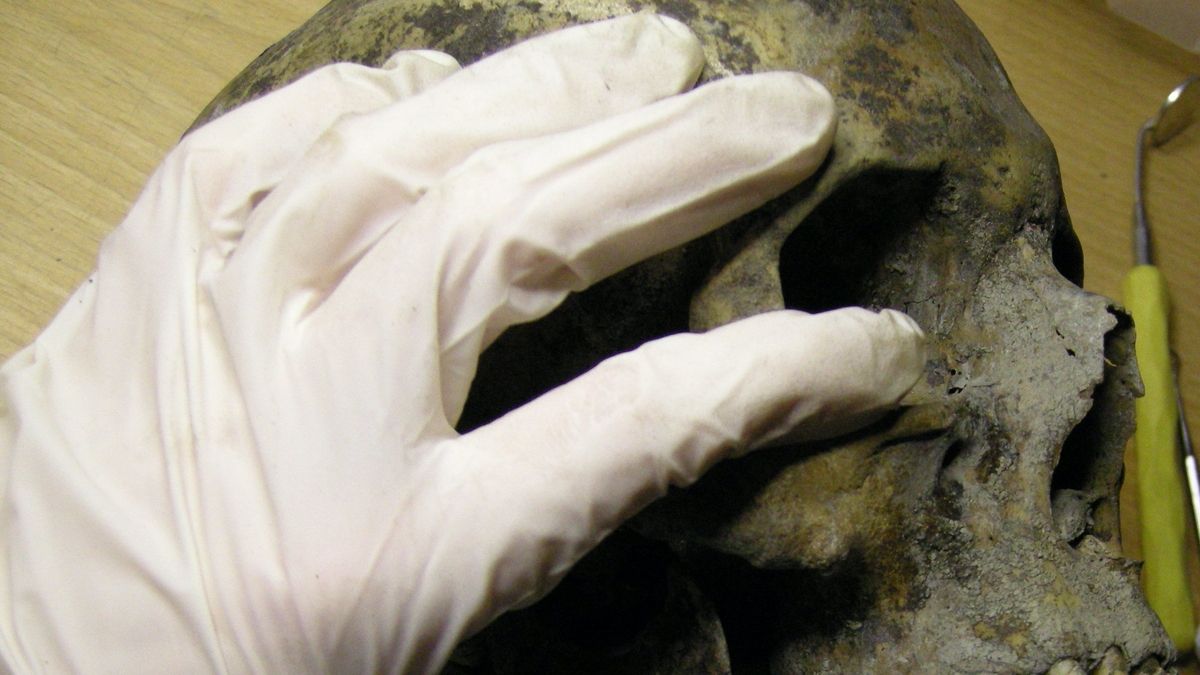 Unearthing Dental Health in the Viking Age An Exploration of Vikings