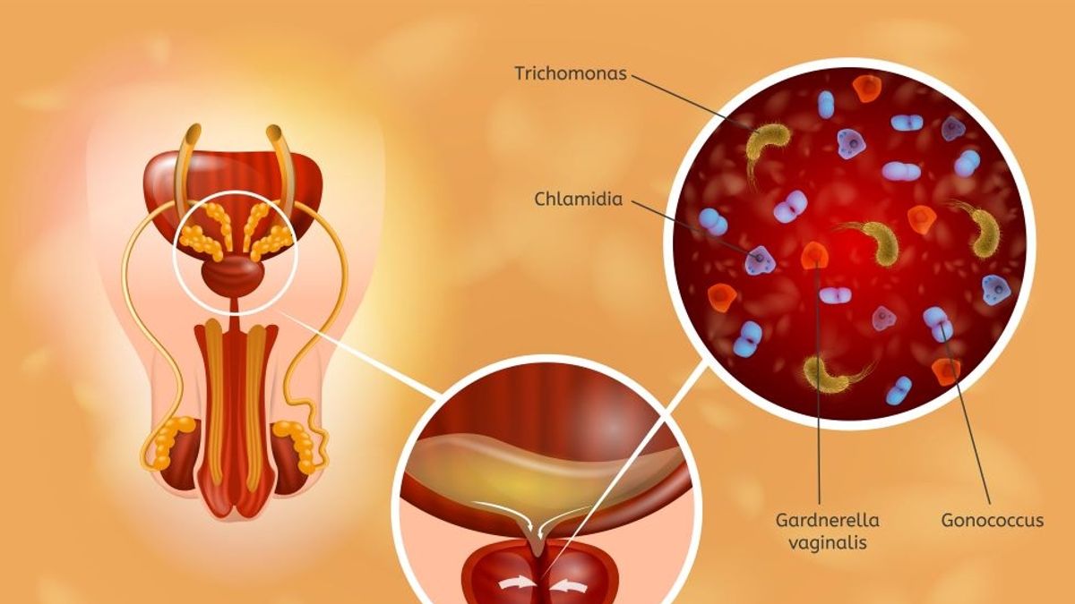 A New Approach to Manage Chronic Prostatitis Chronic Pelvic Pain