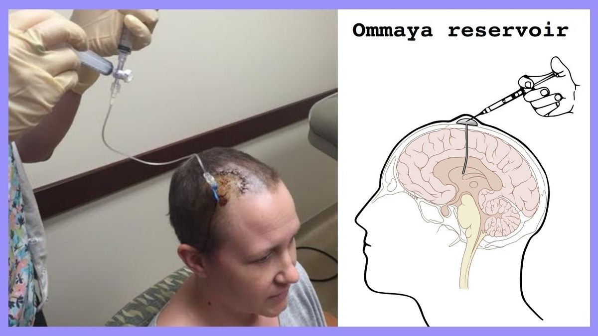 Understanding the Role and Benefits of an Ommaya Reservoir in ...