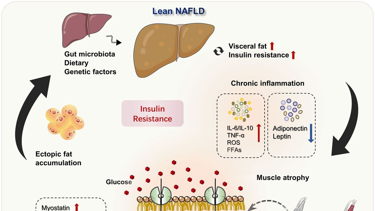 Understanding the Prevalence and Clinical Characteristics of Lean NAFLD ...