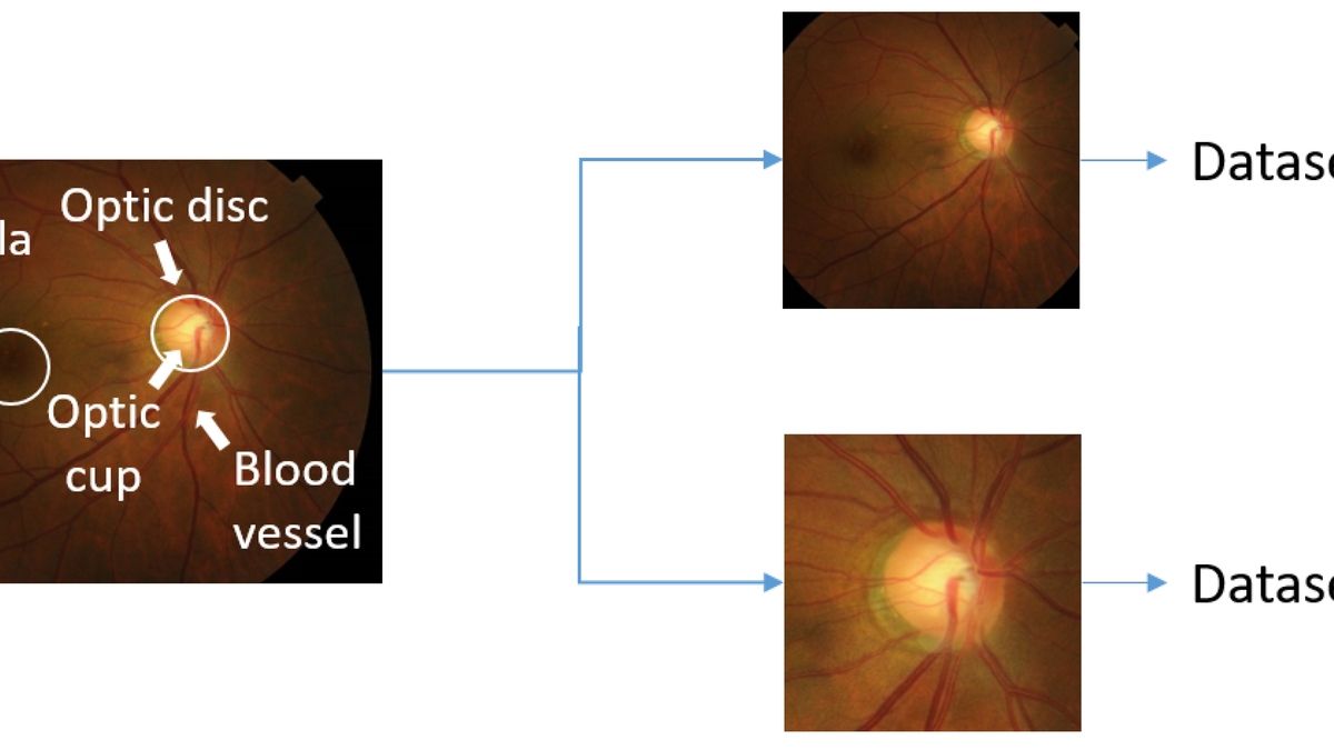 The Future of Optic Disc Abnormalities Classification A Deep Learning
