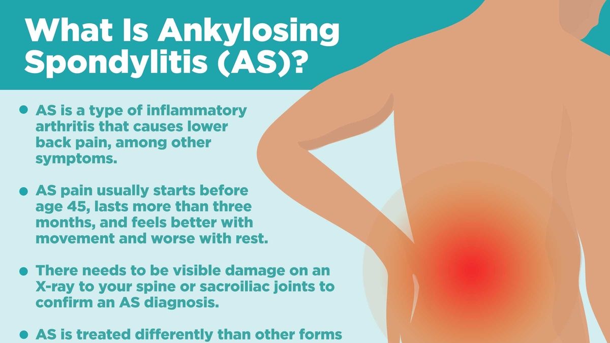 Understanding And Managing Ankylosing Spondylitis A Comprehensive Guide