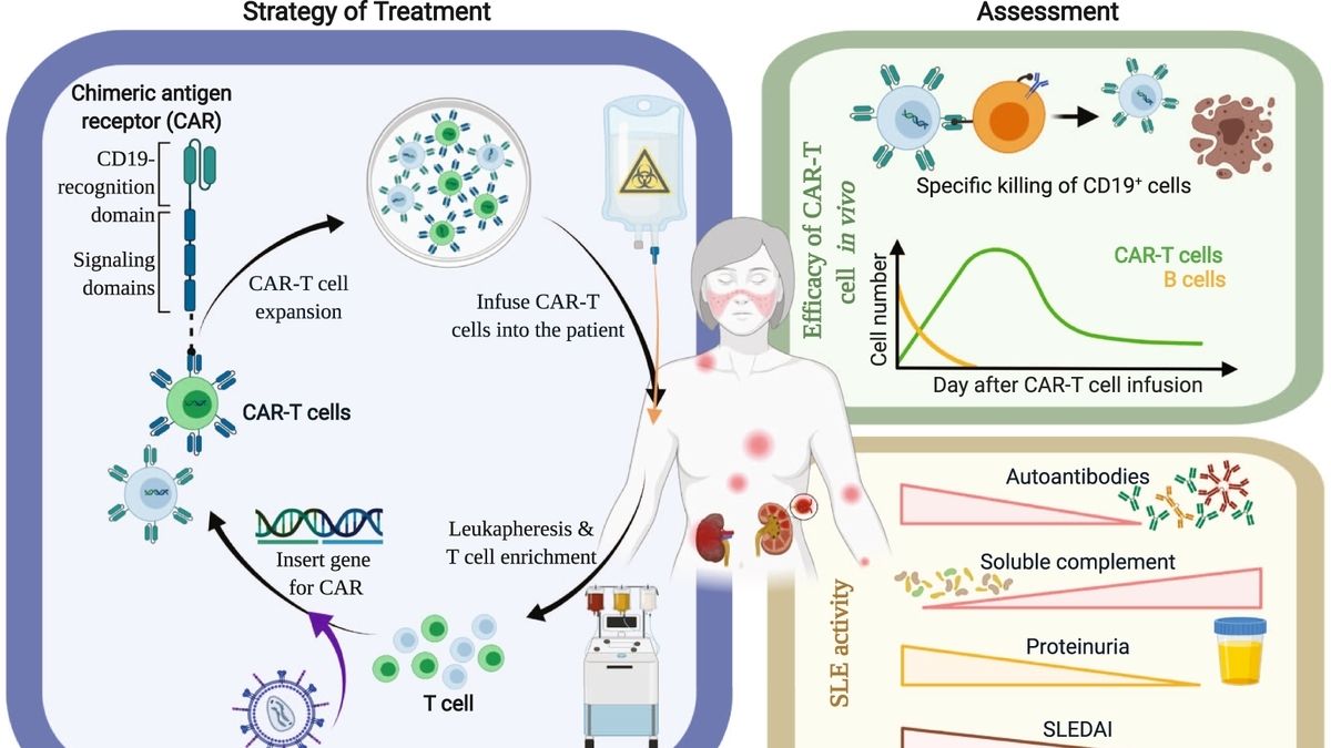 CD19 CAR T-Cell Therapy: A New Hope for Autoimmune Diseases