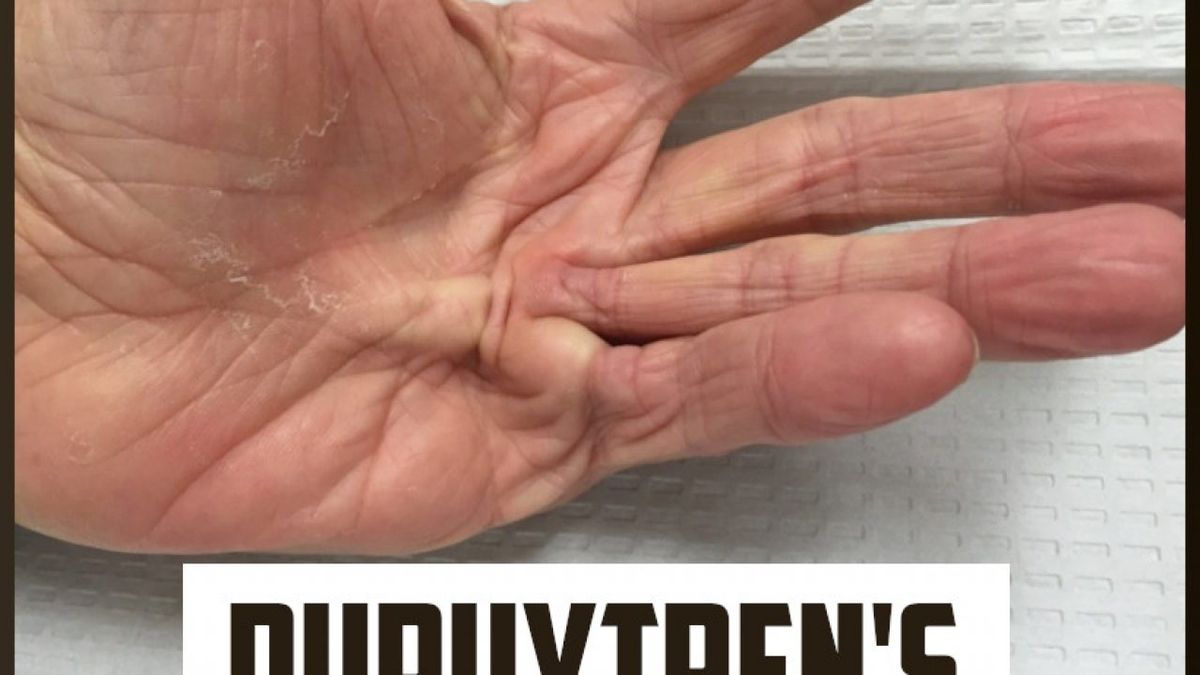 Comparing Treatments for Dupuytren Contracture: A Closer Look at ...