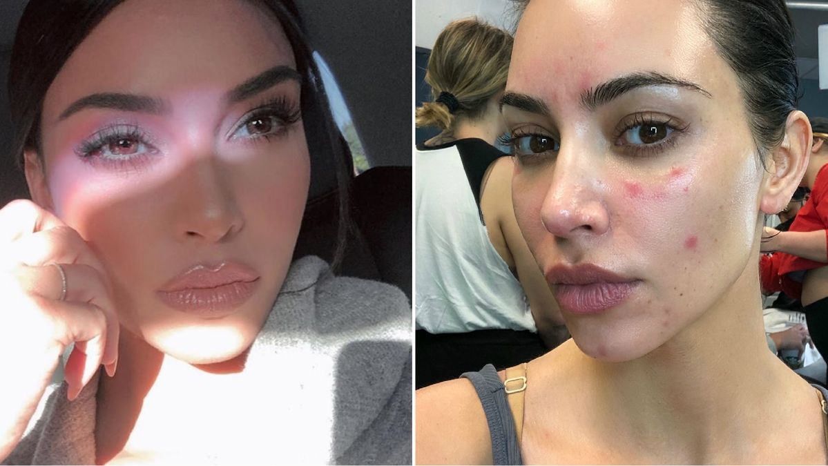 Kim Kardashian's Struggle with Psoriasis: Insights and Practical Advice