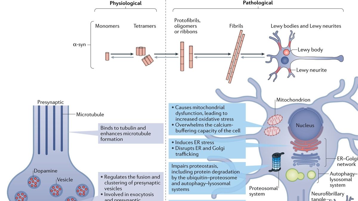 Understanding the Progression of Synucleinopathy in Parkinson's Disease ...