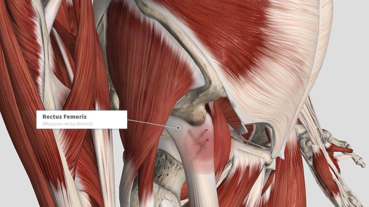 Understanding the Implications of a Proximal Rectus Femoris Tendon Tear ...