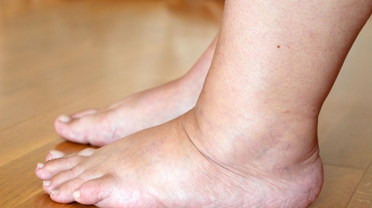 7 Warning Signs of Liver Failure in Your Legs and Feet