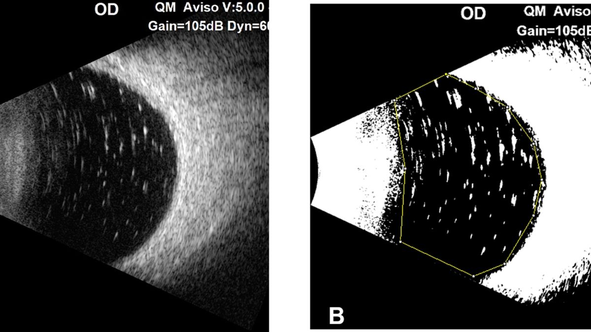 Understanding Residual Silicone Oil Following Vitrectomy Challenges